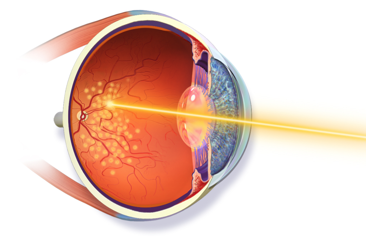 Can You Prevent and Treat Retinal Detachment?